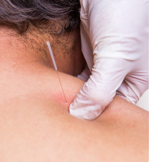 Dry Needling
